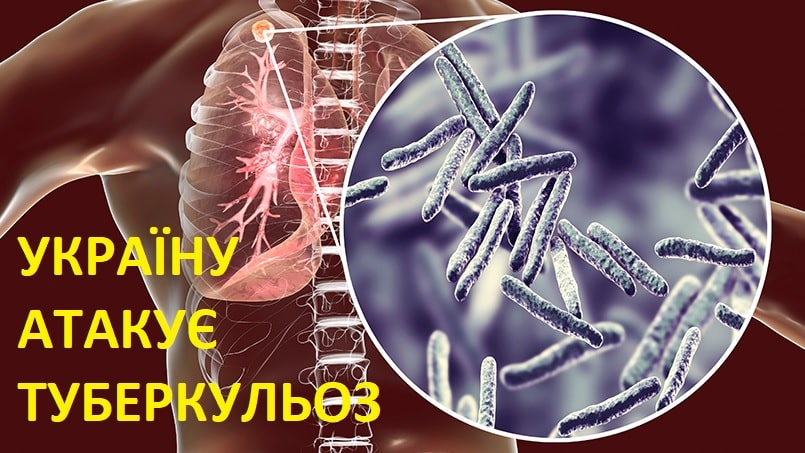 Україну атакує туберкульоз